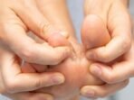 Kenali Obat untuk Mengatasi Jamur Kulit